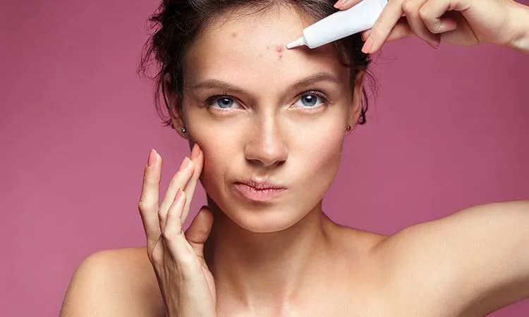 Jak pozbyć się pryszcza w 24h? Szybkie sposoby i triki