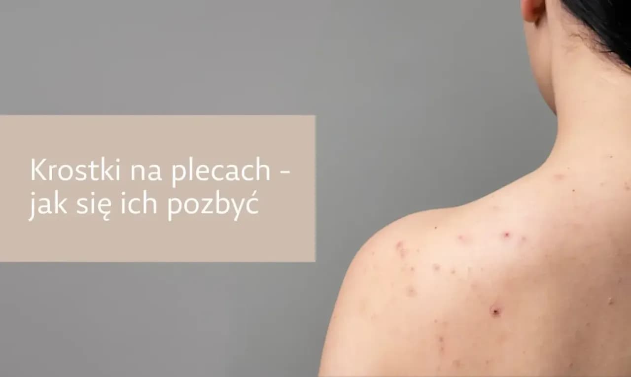 Jak pozbyć się pryszczy na plecach? Skuteczny przewodnik