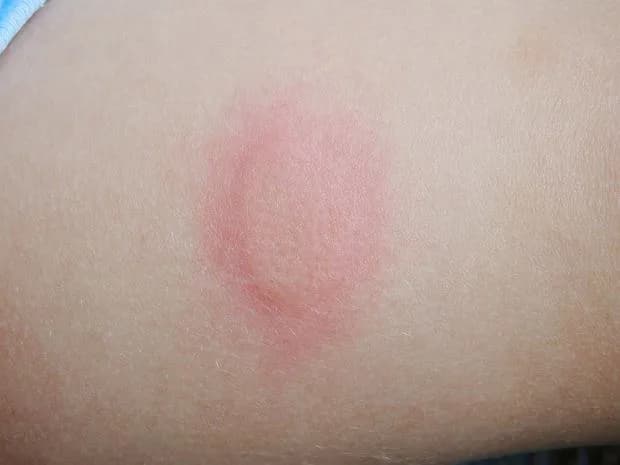 Bolesne gule pod skórą: Szybkie sposoby leczenia i zapobiegania