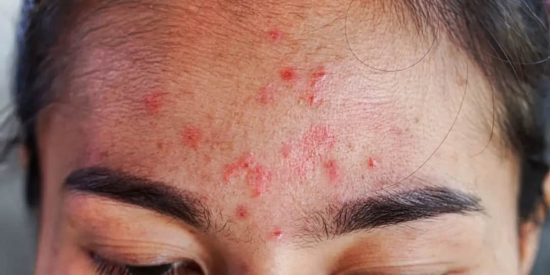 Pryszcze u dorosłych: poznaj główne przyczyny i skuteczne rozwiązania