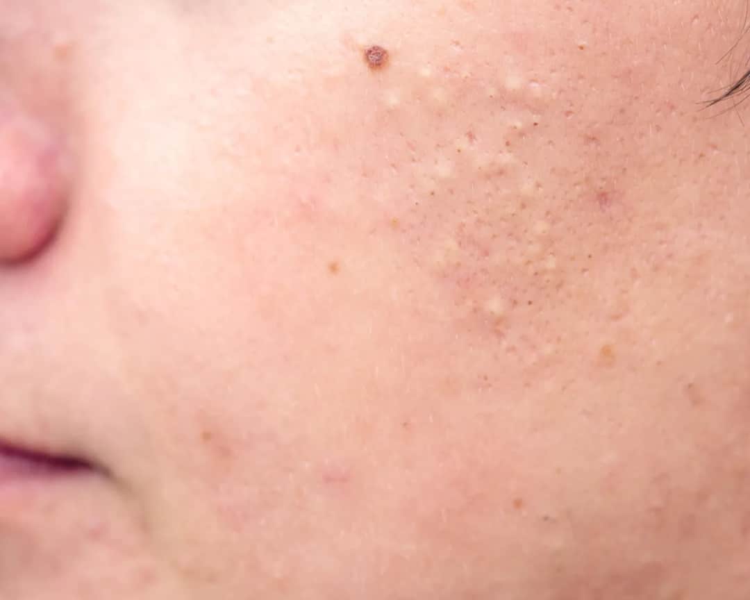 Jak pozbyć się pryszcza pod skórą? Skuteczne metody i zapobieganie