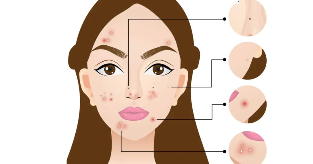 Mapa trądziku: Co lokalizacja pryszczy mówi o Twoim zdrowiu?