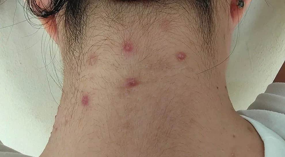 Pryszcze na szyi: przyczyny, leczenie i jak się ich pozbyć?