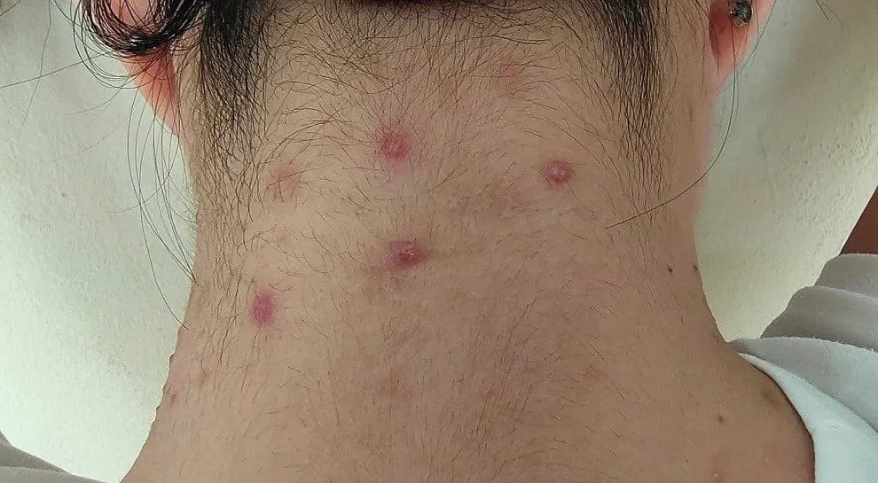 Pryszcze na szyi: przyczyny, leczenie i jak się ich pozbyć?